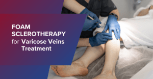 Foam Sclerotherapy For Varicose Veins Treatment
