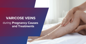 Varicose Veins During Pregnancy Causes And Treatments
