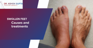 Patients Swollen Feet