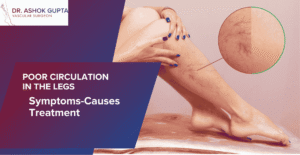 Featured Image For Blog On Poor Circulation In The Legs Symptoms, Causes, Treatment