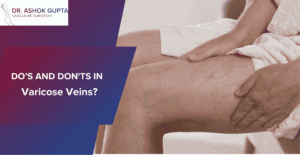 Feature Image Of Blog With Legs Having Varicose Veins And What Are The Dos And Donts In Varicose Veins