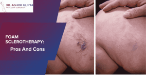 Featured Image Of The Blog _Foam Sclerotherapy Pros And Cons