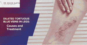 Featured Image For The Blog Title Dilated Tortuous Blue Veins In Legs Causes And Treatment