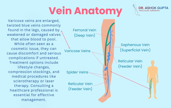 Dilated Tortuous Blue Veins In Legs