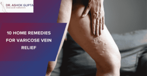 10 Home Remedies For Varicose Vein Relief