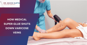 How Medical Super-Glue Shuts Down Varicose Veins