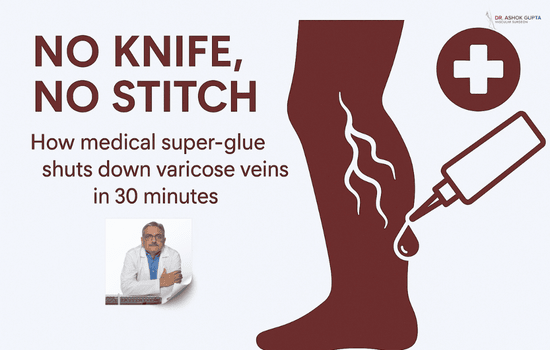 No Knife No Stitch How Medical Super Glue Shuts Down Varicose Veins