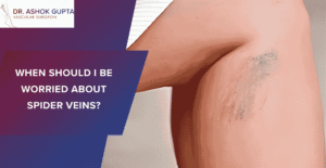 When Should I Be Worried About Spider Veins