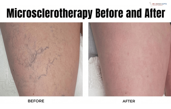 Decoding Microsclerotherapy: A Definitive Guide For Addressing Spider Veins In Dubai Microsclerotherapy Before And After Results