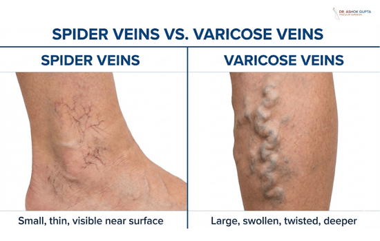 Decoding Microsclerotherapy: A Definitive Guide For Addressing Spider Veins In Dubai Spider Veins Vs. Varicose Veins