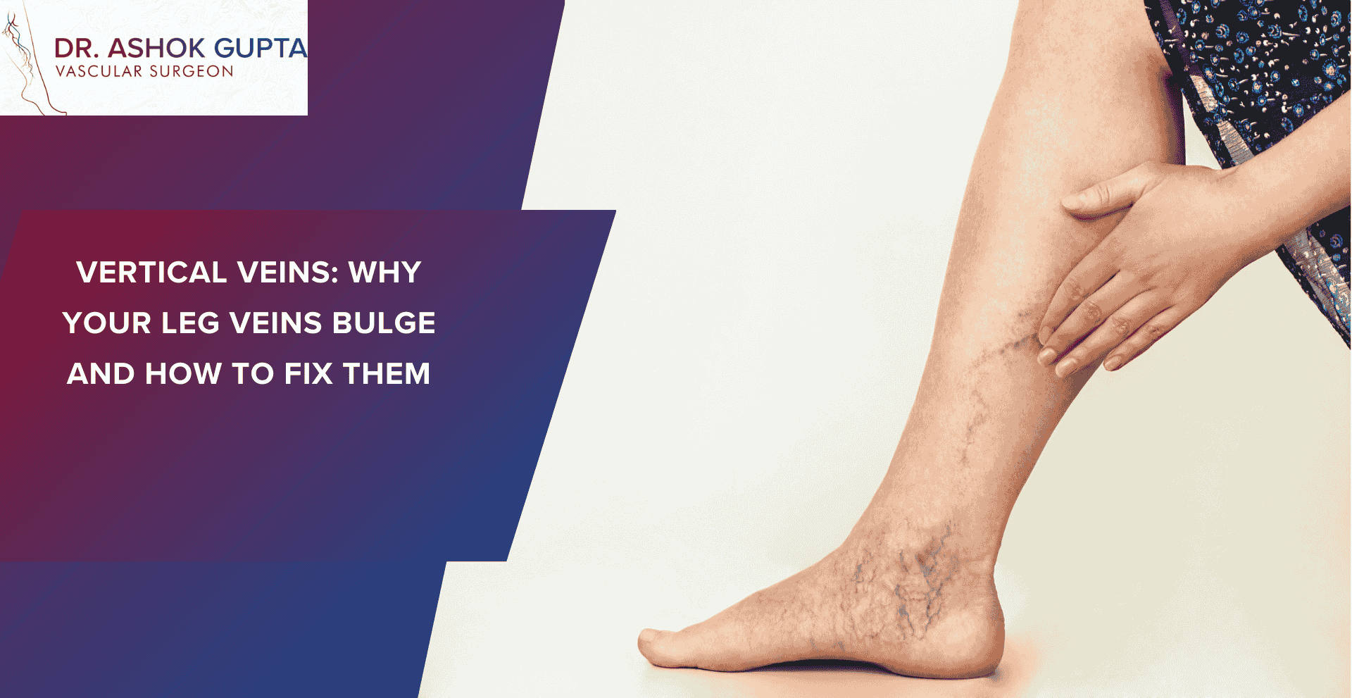 Vertical Veins Why Your Leg Veins Bulge And How To Fix Them