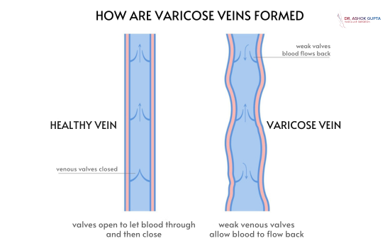 How Are Varicose Veins Formed