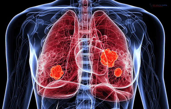 Pulmonary Embolism Is A Blockage Of One Of The Blood Vessels In The Lungs